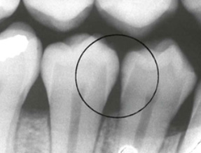 Image A: R1 decay on the premolars