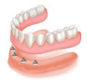 Complete lower implant supported denture