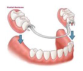 Partial lower denture